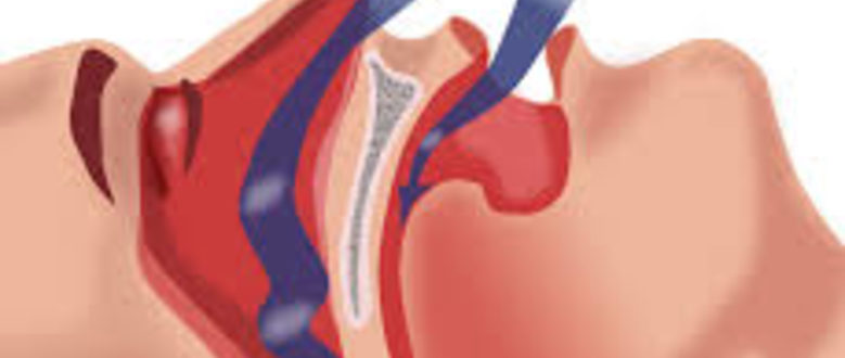 Sistema para a detección do síndrome de Apnea-Hipopnea