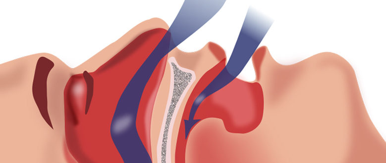 Sistema para a detección do síndrome de Apnea-Hipopnea
