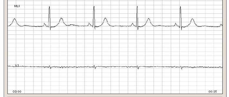 BEATLab: Software para a visualización e anotación do Electrocardiograma
