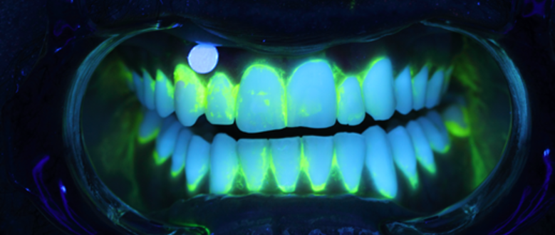 DenTiUS Plaque: Unha ferramenta web de análise de imaxe para o diagnóstico e a cuantificación dos niveis de placa bacteriana