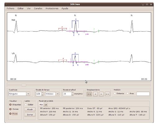 BEATLab: Software para a visualización e anotación do Electrocardiograma