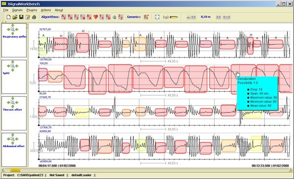 Sistema para a detección do síndrome de Apnea-Hipopnea